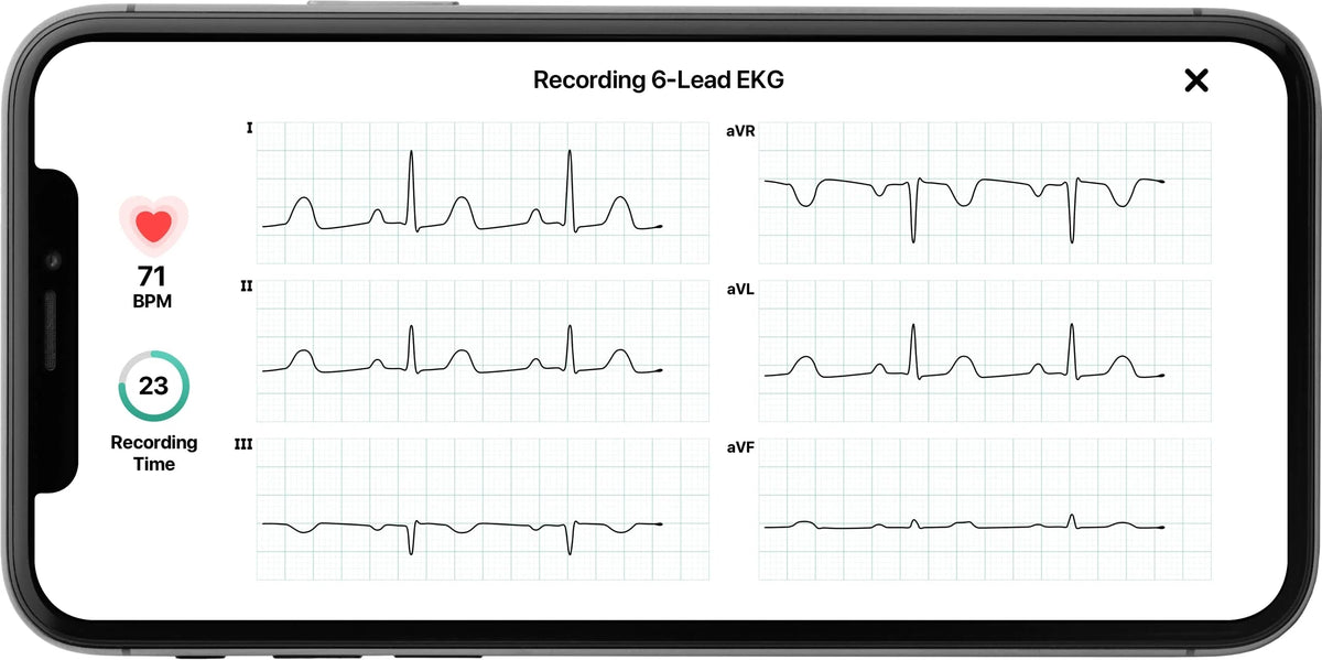 AliveCor KardiaMobile 6L Personal EKG Monitor, Black - KM-6L-E